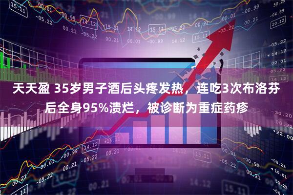 天天盈 35岁男子酒后头疼发热，连吃3次布洛芬后全身95%溃烂，被诊断为重症药疹
